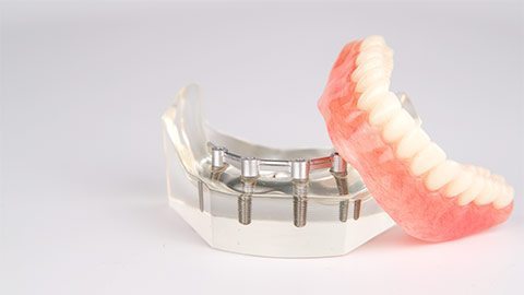 Dental Implants Importance vs Dental Bridges