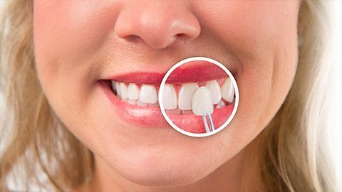 KOR Teeth Whitening Special