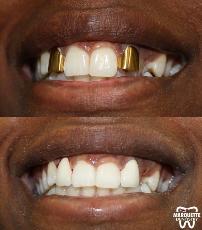 dental implants in Katy TX