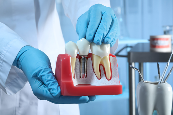 Implant Crowns: The Key To Restoring Missing Teeth